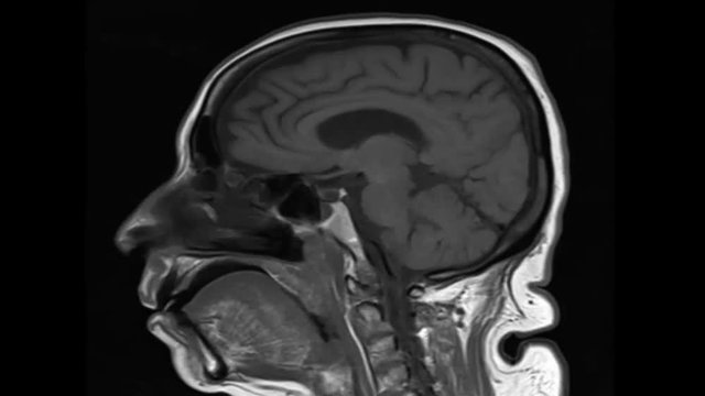 MRI of the brain ,sagittal view. medical footage concept.
