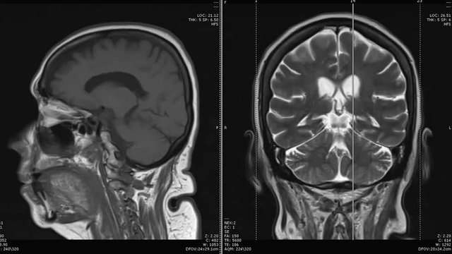 Compare image ,MRI of the brain sagittal and coronal plane,  T1 ,T2