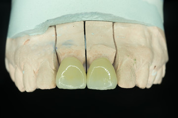 all ceramic crown in model