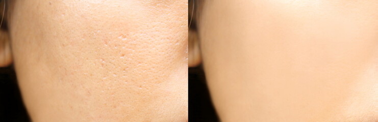 Compare before and after (retouch photo) of close up wide pores skin on oily face have pimple of...