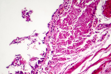 Chronic bronchitis, photo under microscope, light micrograph