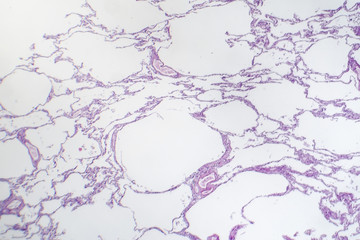 Diffuse lung emphysema, light micrograph, photo under microscope