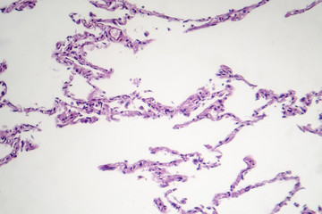 Diffuse lung emphysema, light micrograph, photo under microscope