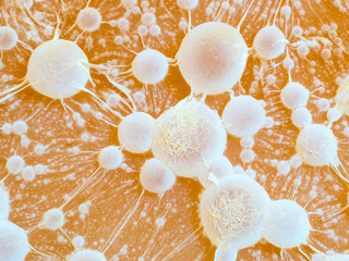 cancer tumour.