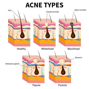 Acne types. Pimple skin diseases anatomy medical vector diagram. Illustration of follicle and pimple, medicine anatomy, papule and pustule