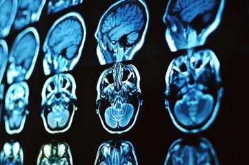 Fototapeta na wymiar Magnetic resonance image scan of the brain. MRI film of a human skull and brain. Neurology background. Medicine, science, side view