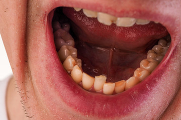 Fototapeta premium Malocclusion. Crowding of the teeth of the lower jaw. Close-up of a man mouth with crooked teeth.