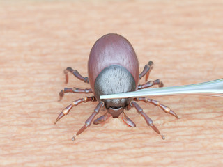 3d rendered illustration of a tick being removed