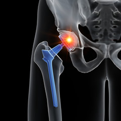 3d rendered medically accurate illustration of a hip replacement