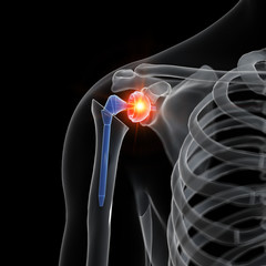 3d rendered medically accurate illustration of a shoulder replacement - obrazy, fototapety, plakaty