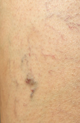 varices en la pierna de una mujer debido a la mala circulación