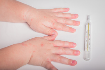 illness, fever, temperature, blisters in a child's arms, a thermometer