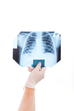 The doctor is studying an x-ray image of the human chest to identify pneumonia.