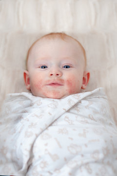 Traces of an allergy on the baby's cheeks, marbling of the skin on the hands