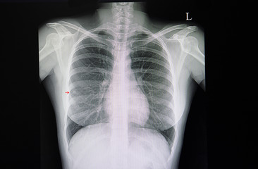 pulmonary nodules