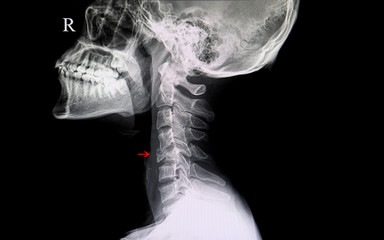 Xray of fractured cervical spine. Lateral neck film of spinal fracture.
