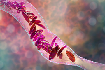 Sickle cell anemia, 3D illustration. Clumps of sickle cell block the blood vessel - obrazy, fototapety, plakaty