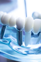 Dentist dental teeth implant