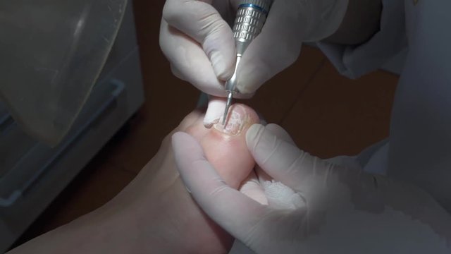 podology intervention close up