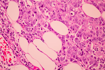 View in microscopic of pathology cross section tissue ductal cell carcinoma or adenocarcinoma diagnosis by pathologist in laboratory.H and E stain.Criteria of breast cancer.Medical concept.