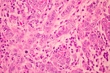 View in microscopic of pathology cross section tissue ductal cell carcinoma or adenocarcinoma diagnosis by pathologist in laboratory.H and E stain.Criteria of breast cancer.Medical concept.