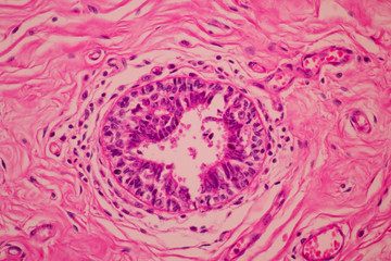 View in microscopic of pathology cross section tissue ductal cell carcinoma or adenocarcinoma...