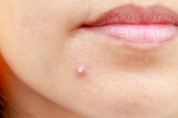 check skin and acne closeup