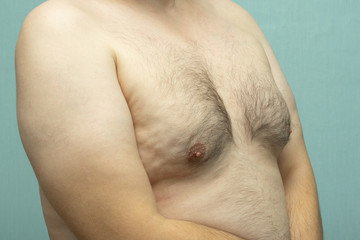 fat white middle-aged man with Gynecomastia, enlarged breast