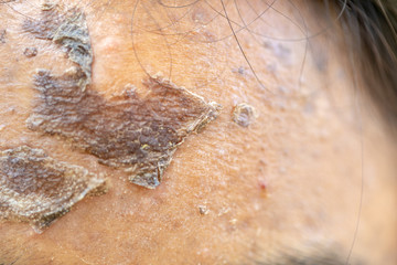 Fototapeta premium Backgrounds of lesions skin caused by acne on the face in the clinic.
