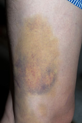 Fototapeta premium Blisters on the skin