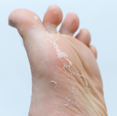 Fototapeta premium Callus on big toe isolated on white background