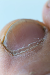 Callus on big toe isolated on white background