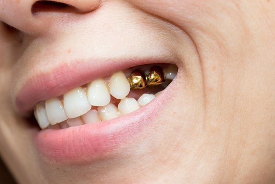 Gold Teeth Images – Browse 28,335 Stock Photos, Vectors, and Video | Adobe  Stock