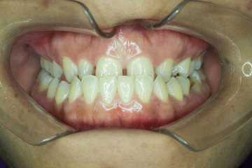 underbite occlusion on closed up view © trailak