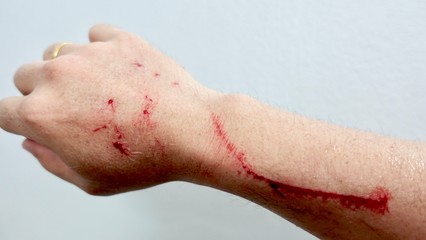 Scratch and Blood on arm after a man try to catch a domestic cat on the road, man's  arm placed on a board with a long slice/cut/wound going across it with blood on it drying up, Healthcare conceptual