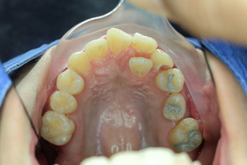 tooth malocclusion in upper jaw © trailak