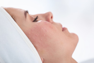 Woman after face biorevitalization procedure in salon, closeup. Cosmetic treatment