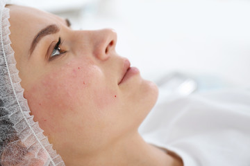 Woman after face biorevitalization procedure in salon, closeup. Cosmetic treatment