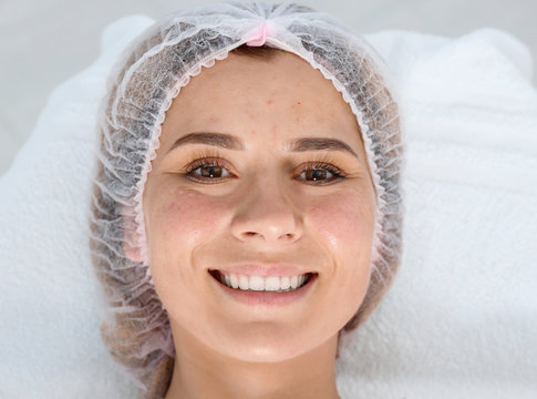 Woman after face biorevitalization procedure in salon. Cosmetic treatment