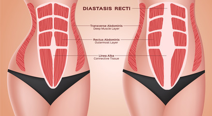 diastasic recti . abdominal . before after pregnancy vector / anatomy - obrazy, fototapety, plakaty