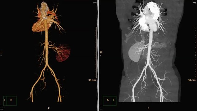 3D rendering and MIP image of CT scan / CTA abdominal aorta with stent graft . medical technology concept.