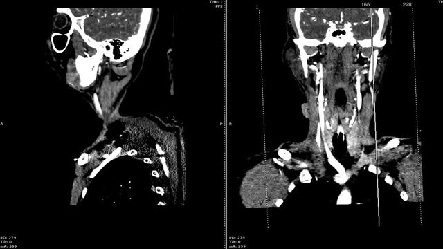 omputed tomography angiography ( CTA ) of the neck post processing image sagittal and coronal plane .