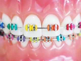 Close up orthodontic model and dentist tool - demonstration teeth model of multi color of orthodontic bracket or brace - obrazy, fototapety, plakaty