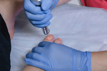 Podiatrist treating toenail fungus. Podology treatment.