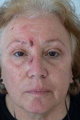 diabetic wounds on face