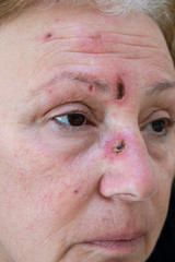 diabetic wounds on face