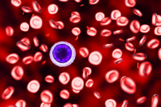 Iron deficiency anemia, 3D illustration showing small hypochromic red blood cells, anisocytosis. A small lymphocyte is drawn for size comparison