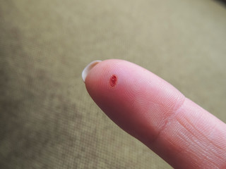 Wound after removing the wart on the finger.