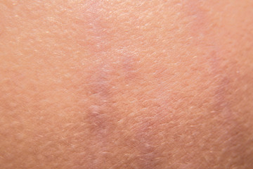 Macro stretch marks of skin