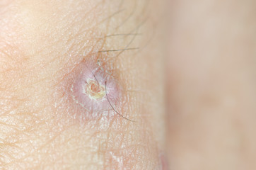 Fototapeta premium Abscess on man hand,select focus